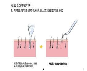 毛囊提取视频,从视频看毛发再生奥秘